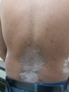 homeopathy doctor for psoriasis treatment in mumbai
