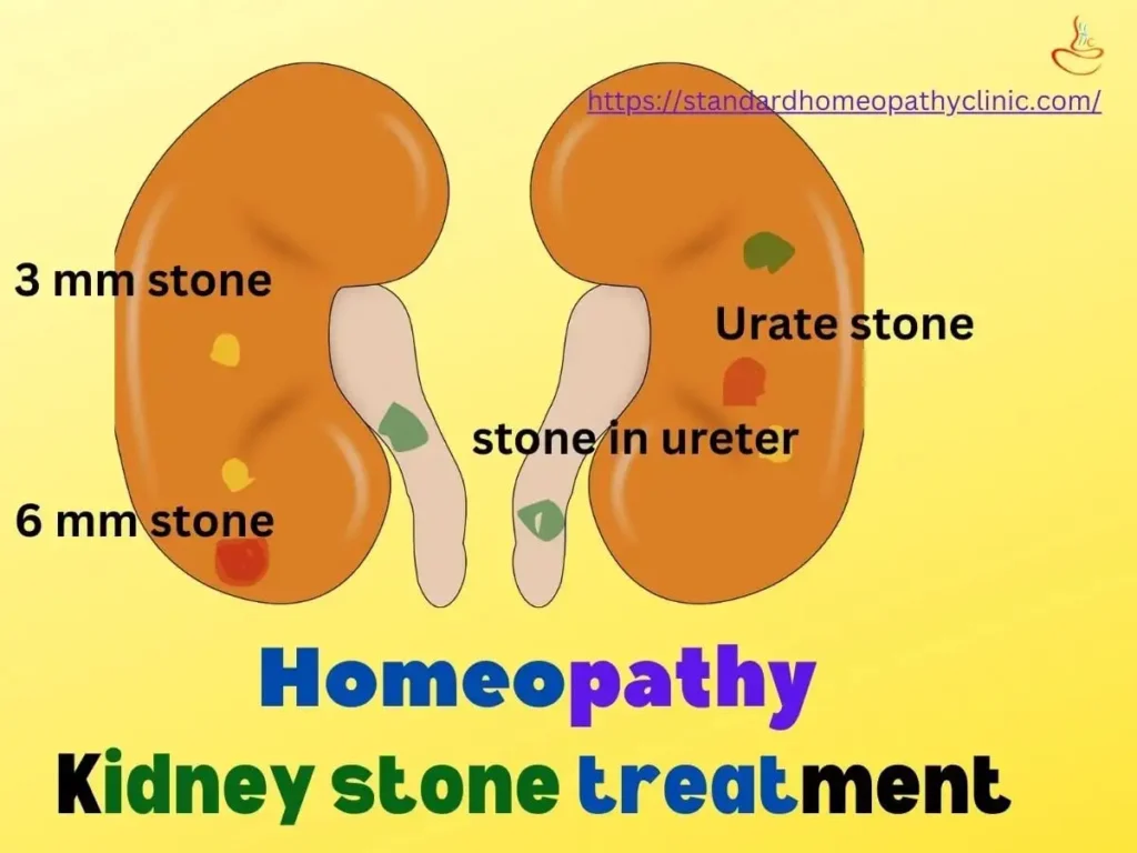 Kidney stones of 3mm, 6mm size, urate stone, treated by homeopathy doctor