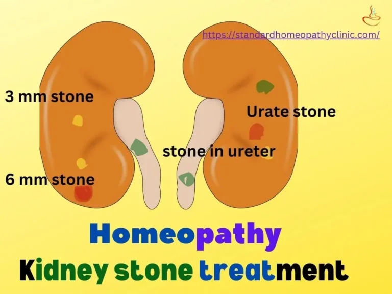 homeopathy doctor for kidney stone treatment of 3mm, 4mm, 5mm, 6mm size, urate stone, multiple stones